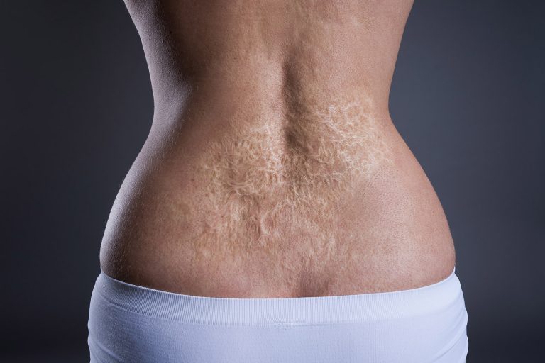 Burn Injuries Scarring